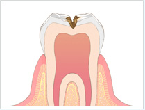 虫歯